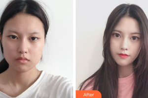 湛江中心人民醫(yī)院燒傷整形手外科黃宇倫整形價格表附下頜角整形案例展示