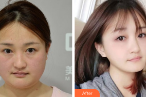 湛江中心人民醫(yī)院燒傷整形手外科陳勁整形價格表附面部吸脂案例展示