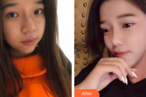 湛江中心人民醫(yī)院燒傷整形手外科陳審整形價格表附激光祛斑案例展示