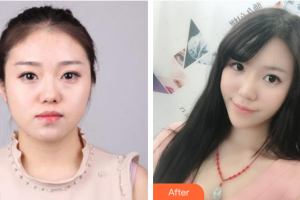 湛江中心人民醫(yī)院燒傷整形手外科黃廣恩整形價格表附埋線提升案例展示