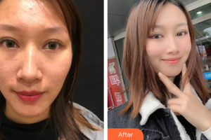 湛江澳泰整形美容醫(yī)院曾兆舜整形價格表附去痘印痘坑案例展示