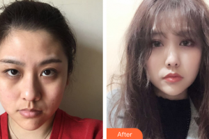 湛江澳泰整形美容醫(yī)院彭新 整形價格表附激光去眼袋案例展示