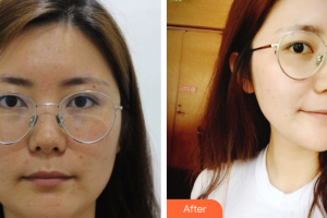 湛江華美整形美容醫(yī)院汪峰整形價格表附面部吸脂案例展示