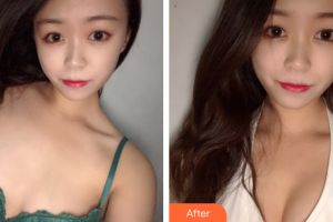 湛江澳泰整形美容醫(yī)院李興均整形價格表附自體脂肪隆胸案例展示