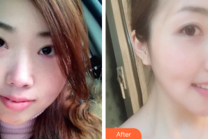 湛江澳泰整形美容醫(yī)院陳突整形價格表附金屬矯正案例展示