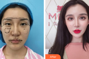 湛江澳泰整形美容醫(yī)院嚴(yán)鐘嫻整形價格表附埋線提升案例展示