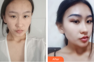 湛江澳泰整形美容醫(yī)院朱志杰整形價格表附眼部手術(shù)案例展示