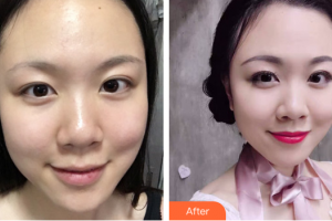 湛江華美整形美容醫(yī)院顏忠蓮整形價格表附激光美膚激光祛斑案例展示