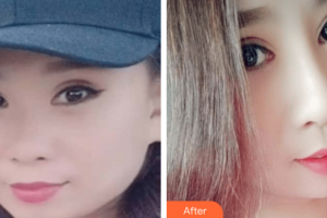 湛江東盟整形美容醫(yī)院張俊整形價格表附鼻部綜合案例展示