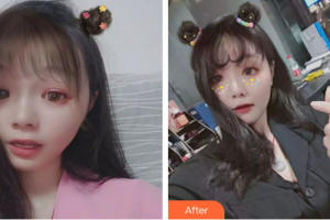 湛江東盟整形美容醫(yī)院王瑤整形價格表附果酸煥膚案例展示