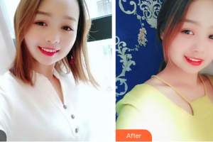 湛江南方口腔醫(yī)院黃宏整形價格表附皓齒美白案例展示