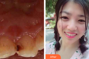 湛江南方口腔醫(yī)院蔡蓮整形價格表附美容冠案例展示