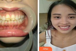 湛江南方口腔醫(yī)院黃和生整形價格表附瓷貼面案例展示