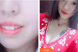 湛江南方口腔醫(yī)院吳曉程整形價(jià)格表附時(shí)代天使矯正案例展示