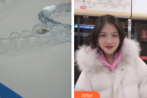 湛江南方口腔醫(yī)院蔡羽飛整形價(jià)格表附隱形矯正案例展示