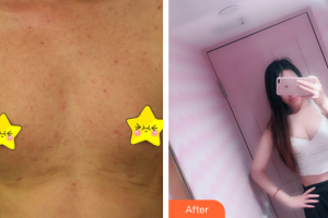 茂名華美整形美容醫(yī)院程國(guó)璽整形價(jià)格表附自體脂肪隆胸案例展示