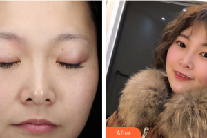 茂名市人民醫(yī)院燒傷整形科董嘉藍(lán)整形價(jià)格表附激光祛斑案例展示