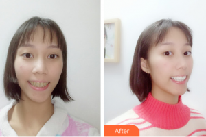 茂名華美整形美容醫(yī)院王玉強(qiáng)整形價(jià)格表附瓷貼面案例展示