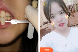 茂名華美整形美容醫(yī)院江敏整形價(jià)格表附超聲波潔牙案例展示