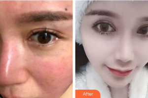 肇慶市皮膚病醫(yī)院醫(yī)療美容科王先文整形價(jià)格表附激光祛紅血絲案例展示