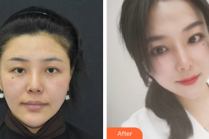 肇慶市皮膚病醫(yī)院醫(yī)療美容科譚以和整形價格表附激光祛斑案例展示