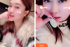 肇慶市皮膚病醫(yī)院醫(yī)療美容科羅中權整形價格表附果酸煥膚案例展示