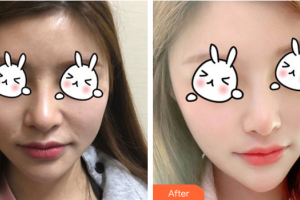 肇慶華美整形美容醫(yī)院蘇暢整形價格表附熱拉提案例展示