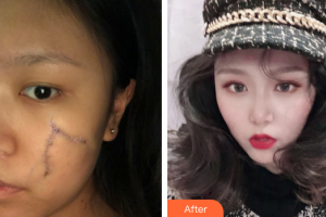 梅州市人民醫(yī)院燒傷整形科何國 整形價格表附縫針疤痕案例展示