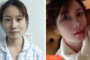 梅州諾麗醫(yī)療美容門診部王利整形價格表附眼部綜合案例展示