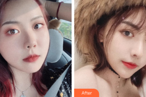 東莞中韓醫(yī)療美容診所喬松整形價格表附眼部綜合案例展示