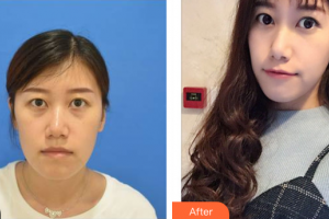 東莞現(xiàn)代女子醫(yī)療美容診所程壽濤整形價格表附激光去眼袋案例展示