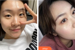 東莞中韓醫(yī)療美容診所秦東方整形價格表附眼部綜合案例展示