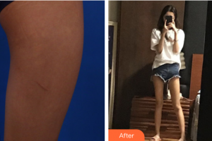 東莞南城人民醫(yī)院醫(yī)學(xué)整形美容中心黨小平整形價格表附大腿吸脂案例展示