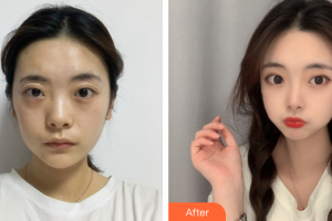 東莞市人民醫(yī)院醫(yī)學(xué)美容科劉玉生整形價格表附抗衰修復(fù)案例展示