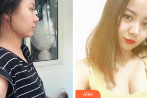 東莞知美整形醫(yī)院蘇萬龍整形價格表附自體脂肪豐胸案例展示