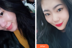 東莞美立方美容醫(yī)院王炳虓整形價格表附豐胸吸脂案例展示