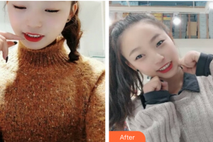 東莞美立方美容醫(yī)院張海鐘整形價(jià)格表附超聲波洗牙案例展示