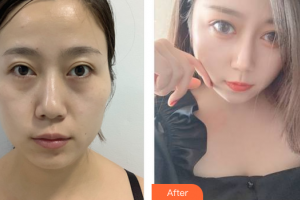 東莞主山愛(ài)康門診部醫(yī)學(xué)整形美容中心廖旭峰整形價(jià)格表附激光去眼袋案例展示