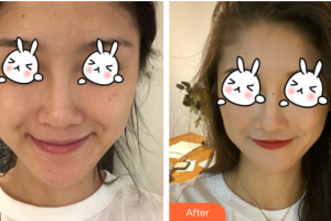 東莞康華醫(yī)院整形美容中心霍麗貞整形價(jià)格表附光子嫩膚案例展示