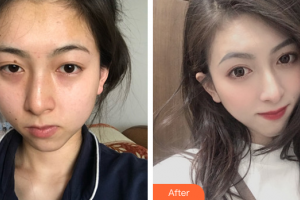 東莞締美整形美容醫(yī)院黃維林整形價(jià)格表附熱瑪吉案例展示