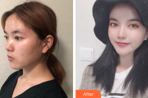 東莞締美整形美容醫(yī)院馬可·斯塔比整形價(jià)格表附埋線提升提升案例展示