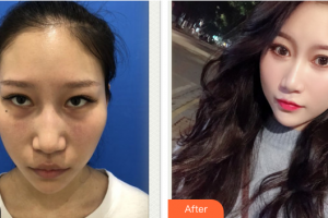 東莞瑞芙臣醫(yī)療美容門診部MichelPfulg整形價(jià)格表附激光去眼袋案例展示