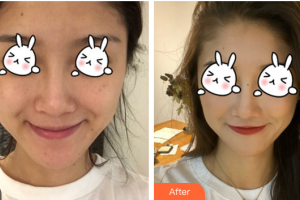 東莞美立方美容醫(yī)院湯曉姝整形價(jià)格表附光子嫩膚案例展示