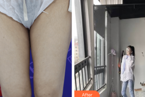 東莞瑞芙臣醫(yī)療美容門診部吳枓映整形價(jià)格表附大腿腰腹環(huán)吸案例展示