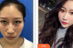 東莞瑞芙臣醫(yī)療美容門(mén)診部王貴賢整形價(jià)格表附激光去眼袋案例展示