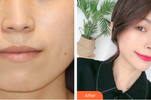 東莞華美醫(yī)療美容醫(yī)院樸莉玲整形價(jià)格表附超激光美膚嫩膚案例展示