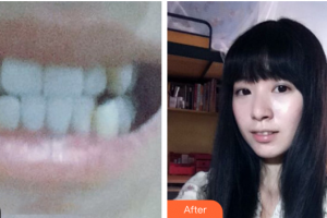 東莞華美醫(yī)療美容醫(yī)院戴俊民整形價(jià)格表附金屬矯正案例展示