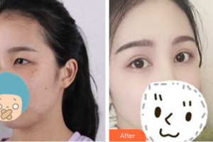 東莞華美醫(yī)療美容醫(yī)院李佳輝整形價(jià)格表附眼部手術(shù)案例展示