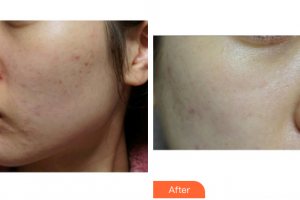 東莞寶格麗醫(yī)療美容門(mén)診部唐可可整形價(jià)格表附清潔祛痘案例展示