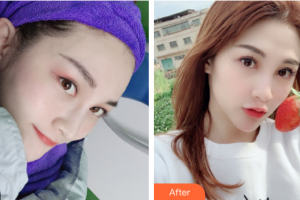 東莞韓美整形醫(yī)院劉小婷整形價(jià)格表附水光補(bǔ)水案例展示